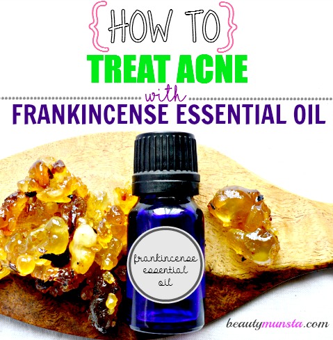 Benefits of frankincense essential oil & recipes for acne!