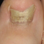 Toefungus