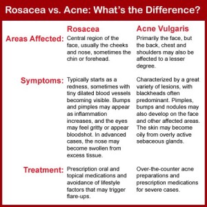 How to tell if you have rosacea or acne! 