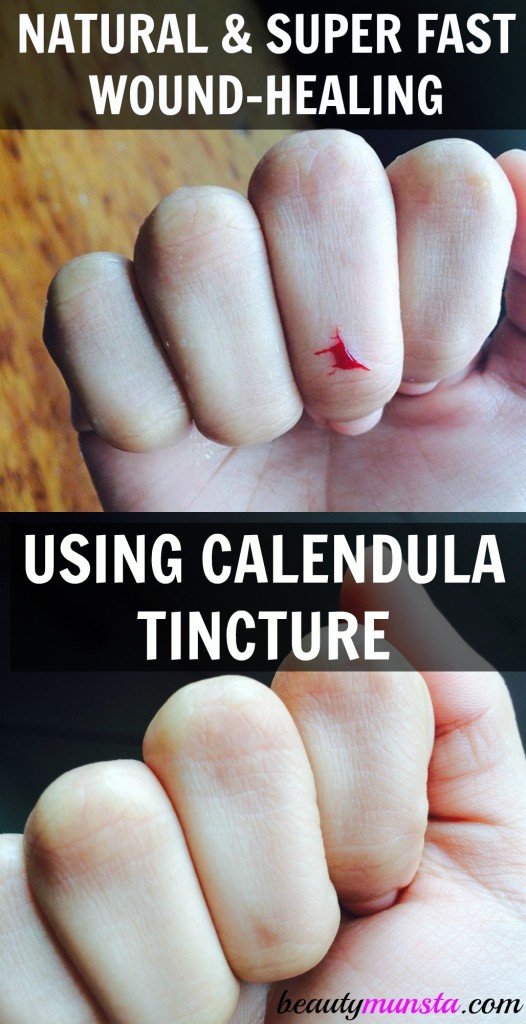 Use calendula as a natural remedy for quickly healing cuts. After picture: 5 weeks