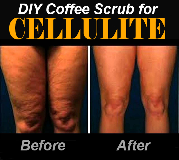 kaffe scrub for cellulite før etter 