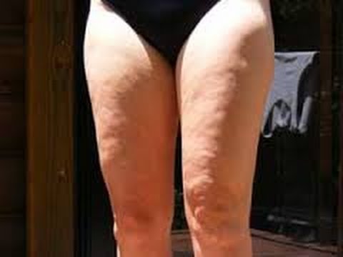 legswithcellulite