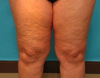 legs with cellulite