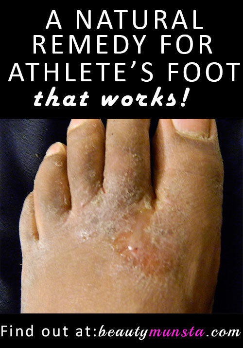 homemade athlete's foot remedy