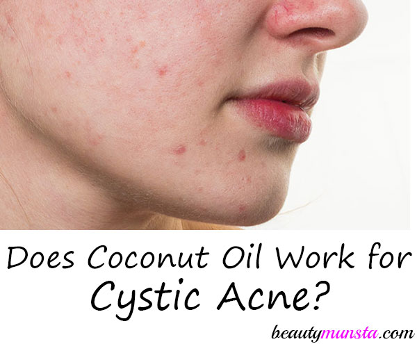 coconut oil and cystic acne