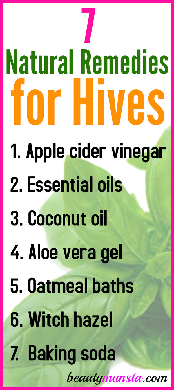 7 Natural Remedies For Hives Beautymunsta Free Natural Beauty Hacks