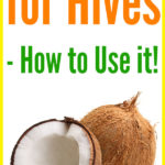 Does Coconut Oil Help with Hives?