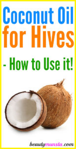 Does Coconut Oil Help with Hives?