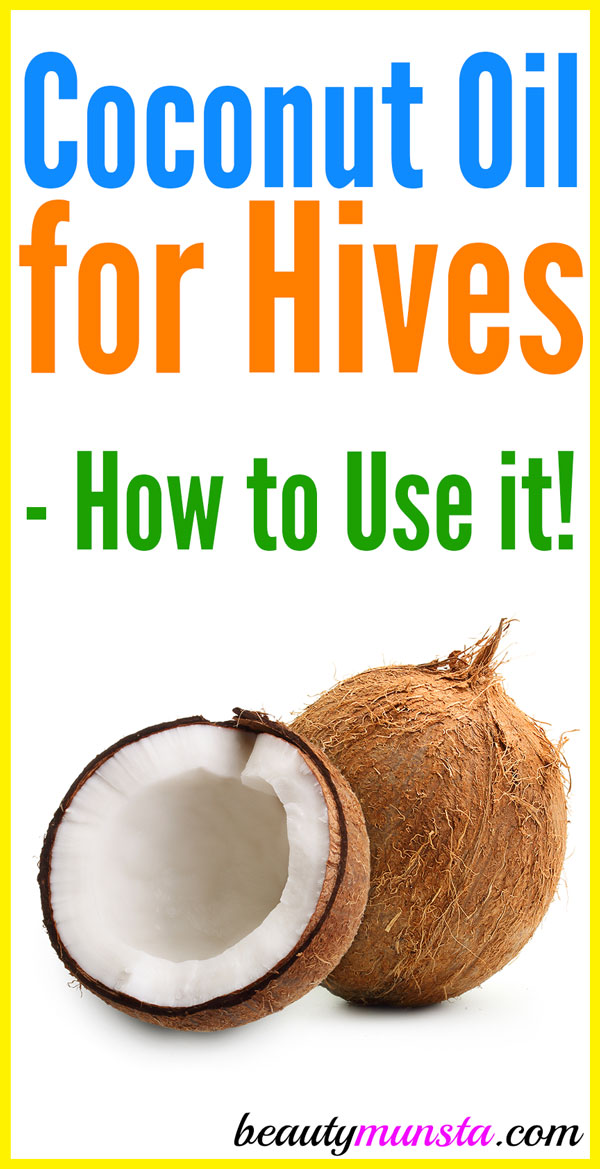 Does coconut oil help with hives? Or do nothing? Or make it worse?! Find out in this post!