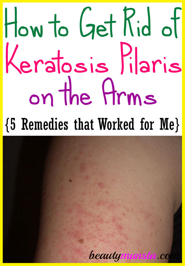 I know how to get rid of keratosis pilaris on arms naturally because I had it and now I don’t!