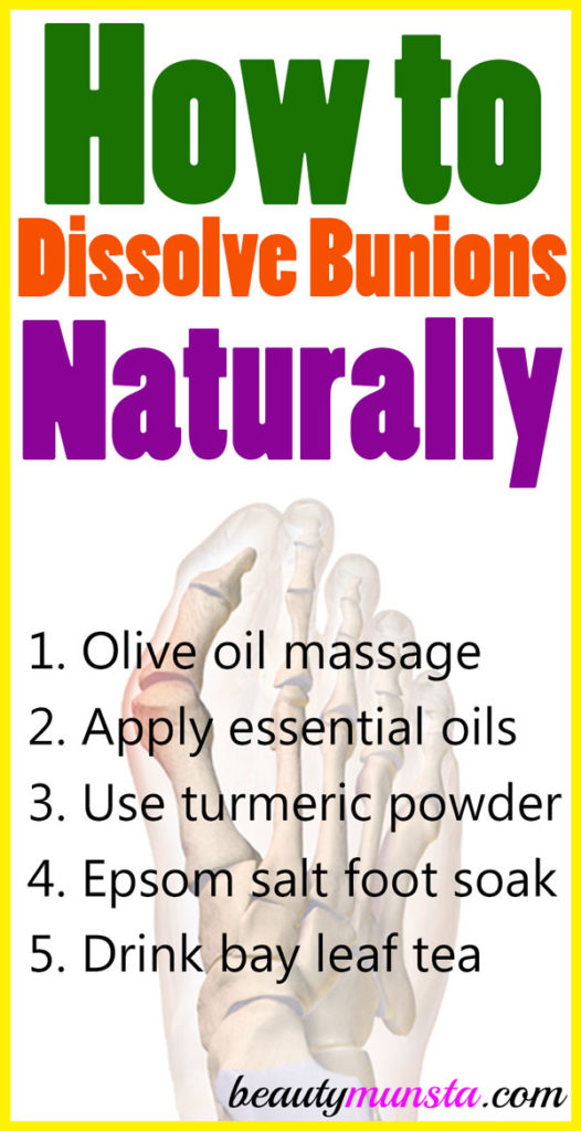 Get to know how to dissolve bunions naturally with 5 natural remedies! 