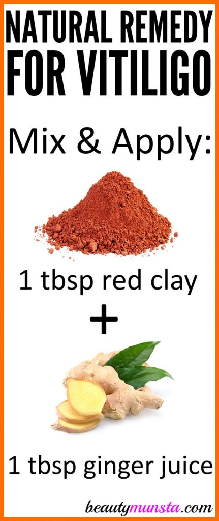 Try red clay for vitiligo daily as a natural treatment.