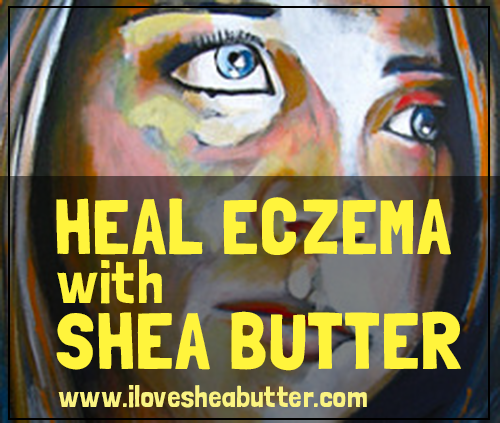 shea butter for eczema