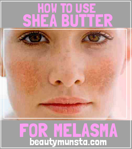 shea butter for melasma relief