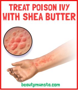 How to Use Shea Butter for Poison Ivy