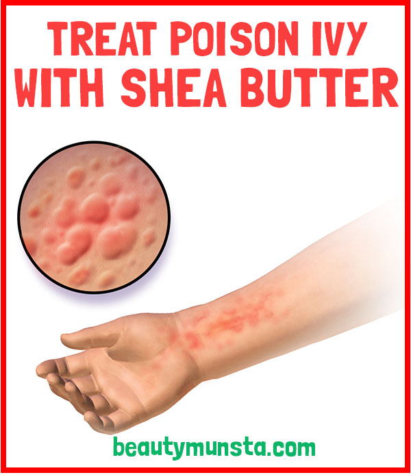 shea butter for poison ivy relief