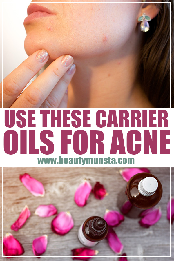 carrier oils for acne