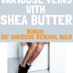 Shea Butter for Varicose Veins + DIY Varicose Removal Balm